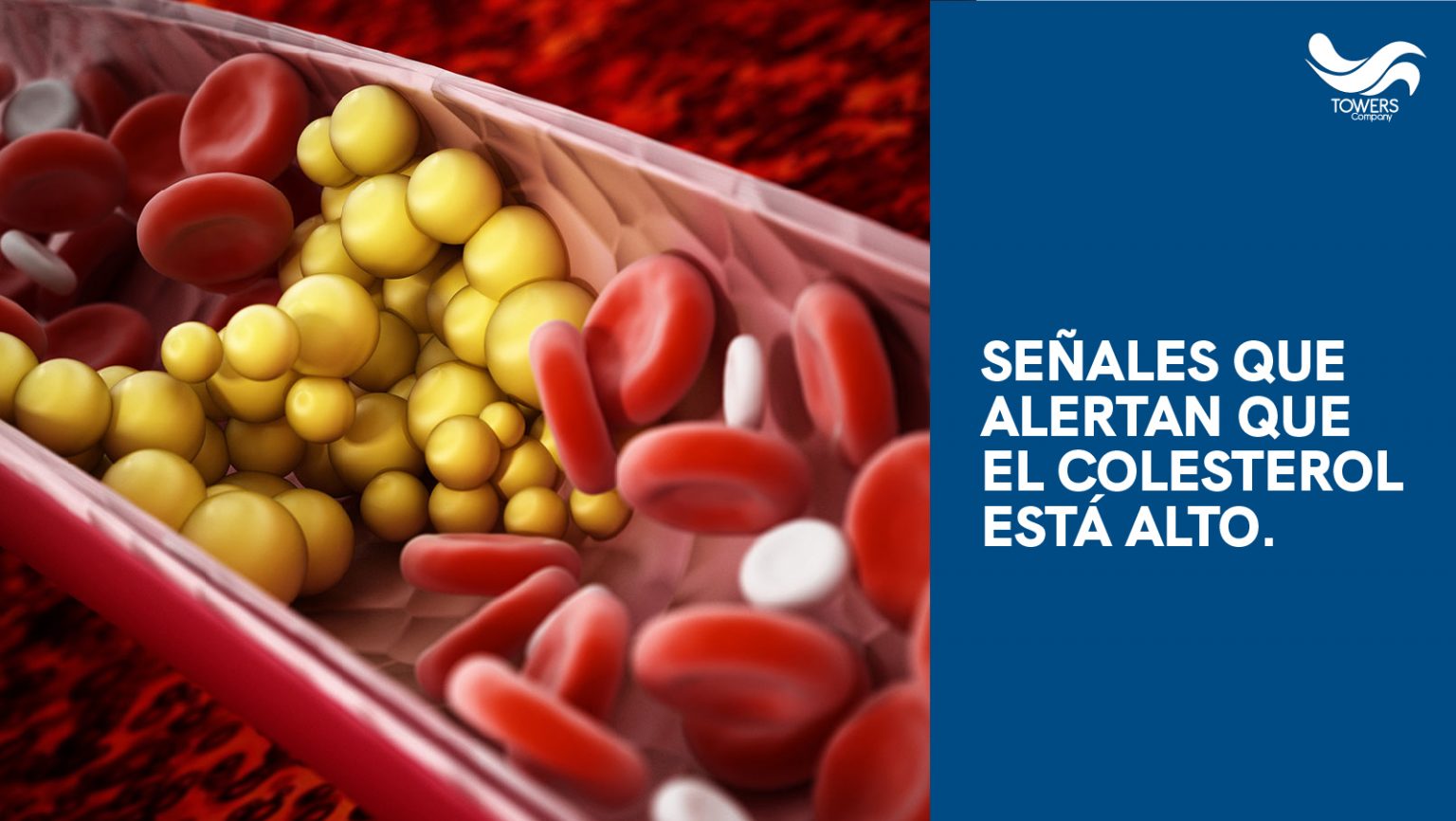 Como Saber Se O Colesterol Está Alto – Sinais De Colesterol Alto – RWIL